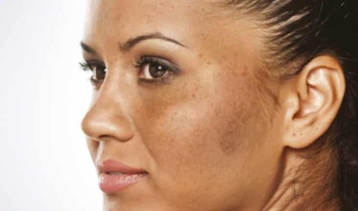 PigmentationTreatmentinMumbai-e1587372243228
